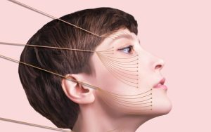 Подтяжка лица нитями: как осуществляется