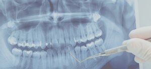 Компьютерная томография зубов: расширенное видение для точного диагноза